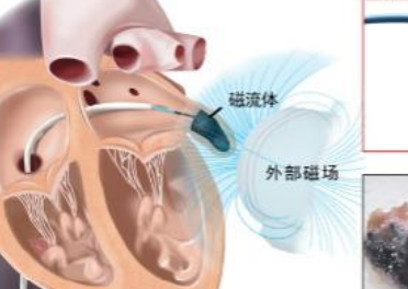 我国科研团队研发新技术开创&ldquo;流体封堵&rdquo;心脏介入治疗范式